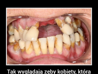 O FUUU! Tak wyglądają zęby kobiety, która przez 10 lat przyklejała je super glue!!!
